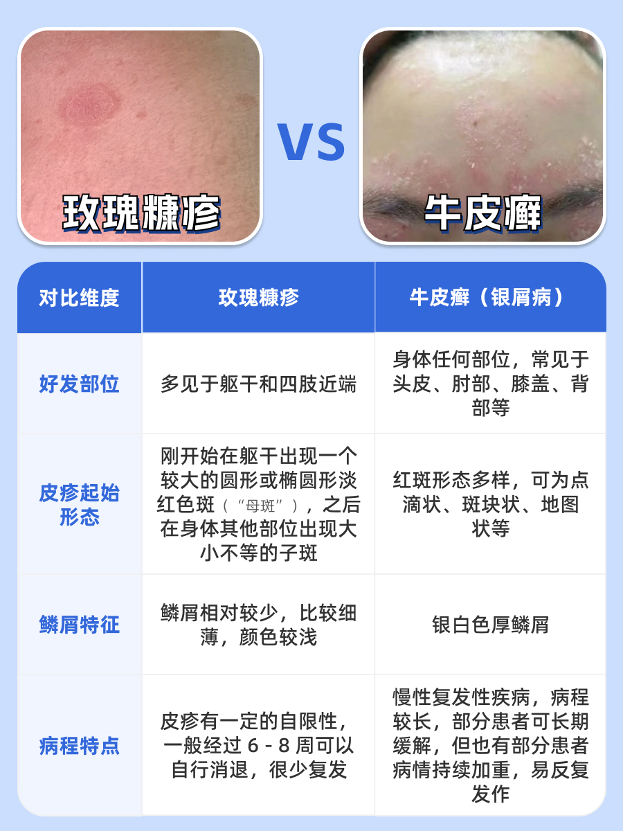 什么容易误诊成银屑病？皮肤科医生来揭秘