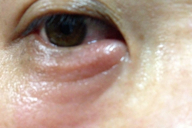 玻尿酸打卧蚕失败图