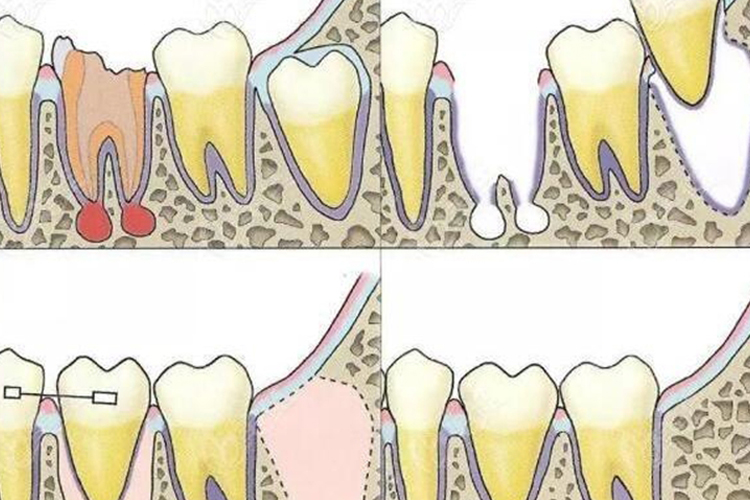 自体智齿移植图