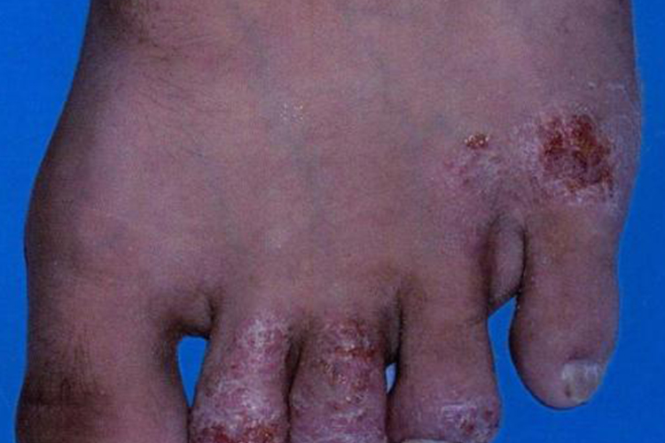 足部亚急性湿疹图 足部亚急性湿疹图