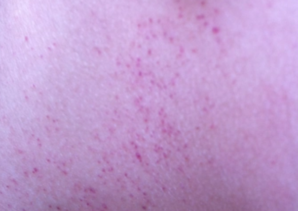 药物所致后背紫色斑点图