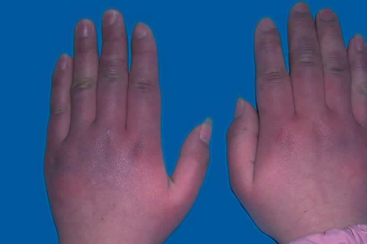 痰栓手部发绀图