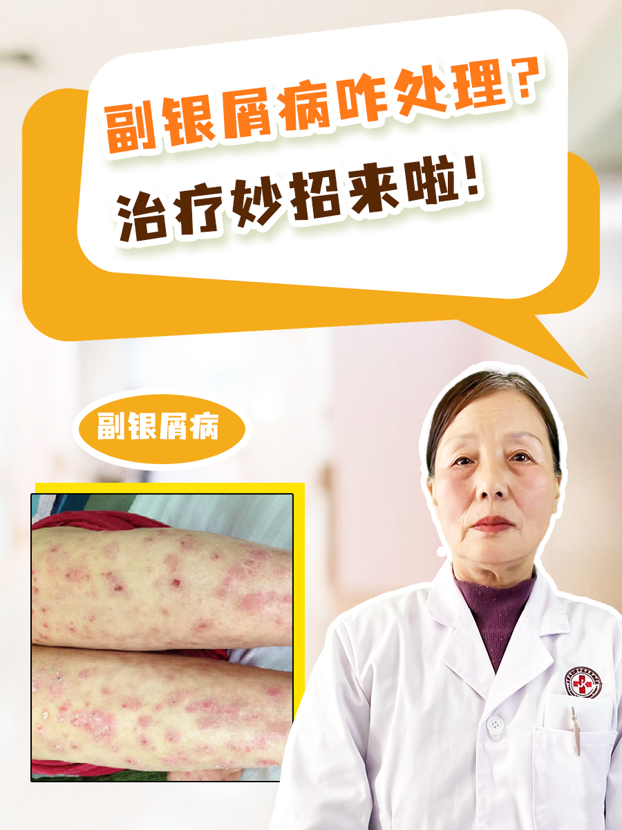 副银屑病咋处理?治疗妙招来啦!