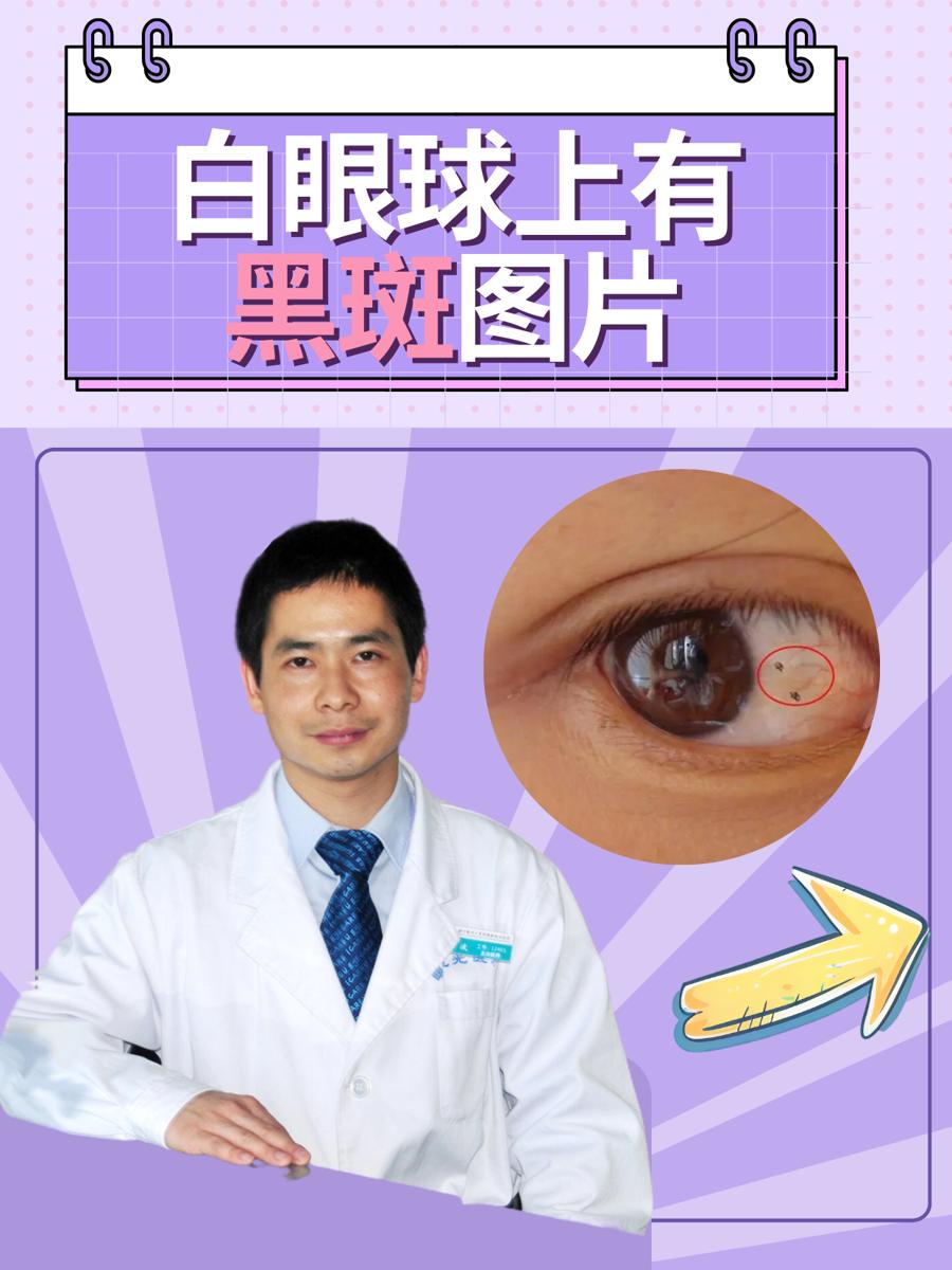 白眼球上有黑斑图片