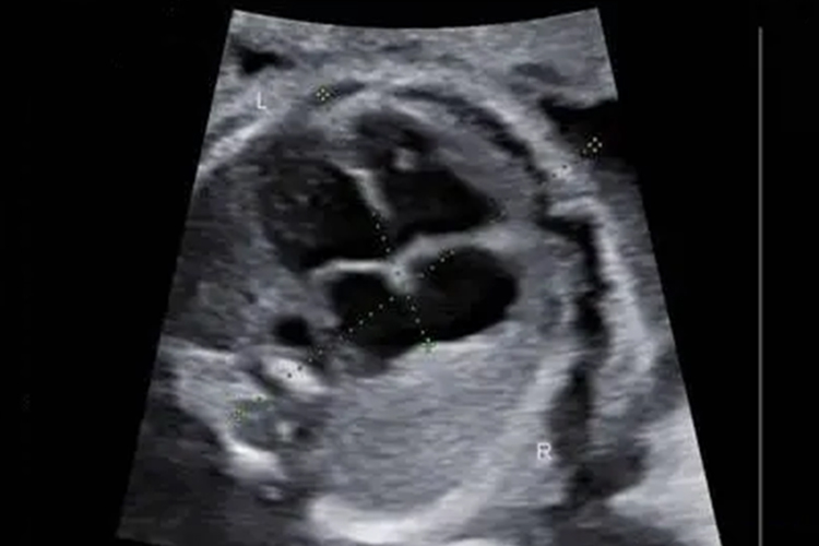 胎儿心脏增宽超声图
