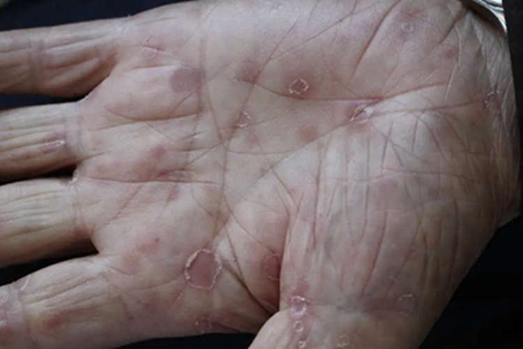 斑疹性梅毒疹手掌红斑图