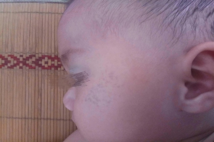 新生儿太田痣图