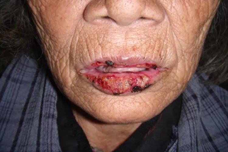 慢性唇炎嘴唇糜烂图片 慢性唇炎嘴唇糜烂图片