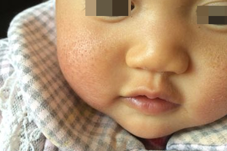 小孩子冬天脸上皲裂图