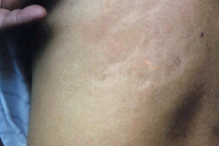 进行性特发性皮肤萎缩症状图