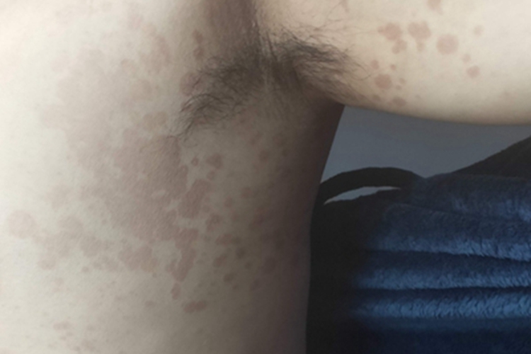 花斑癣胸部有褐色斑片图