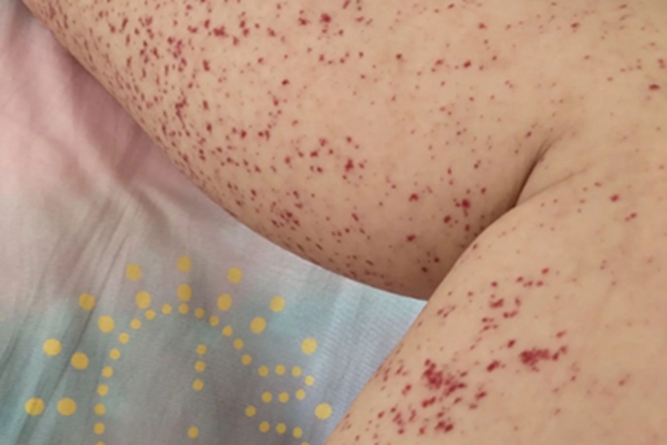 异常蛋白血症紫癜腿部血点图