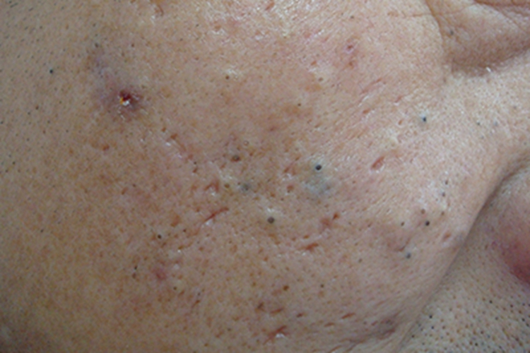 结节性类弹性纤维病面部黑头图 结节性类弹性纤维病面部黑头图