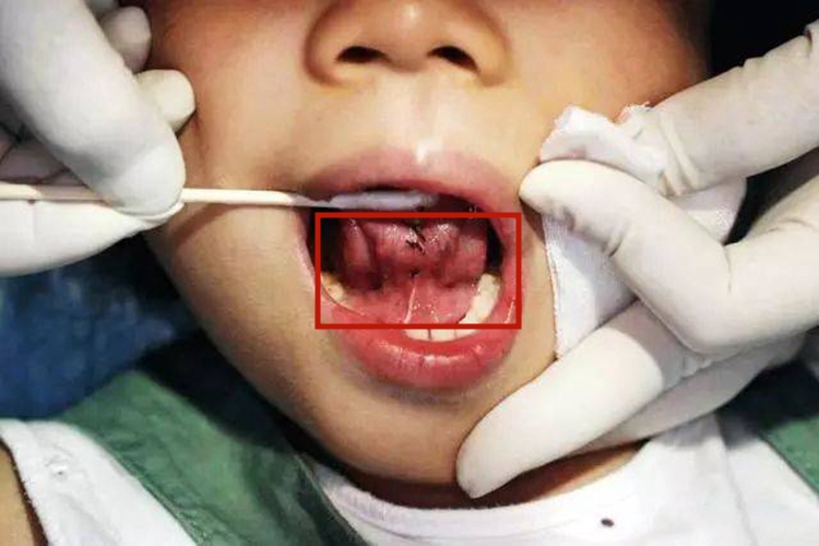 小儿虚火上炎重舌图