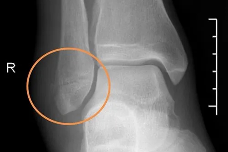 腓骨下端骨折图 腓骨下端骨折图