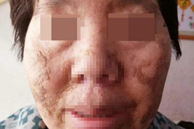 皮肤垢着病斑图