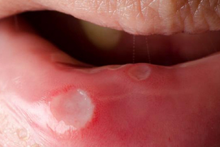 重型阿弗他溃疡嘴唇溃疡图 重型阿弗他溃疡嘴唇溃疡图