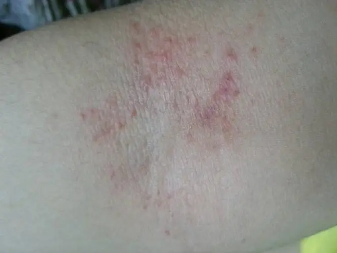 胳膊肘内侧痱子图