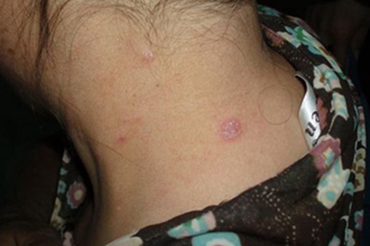 扁平苔藓颈部红斑图 扁平苔藓颈部红斑图