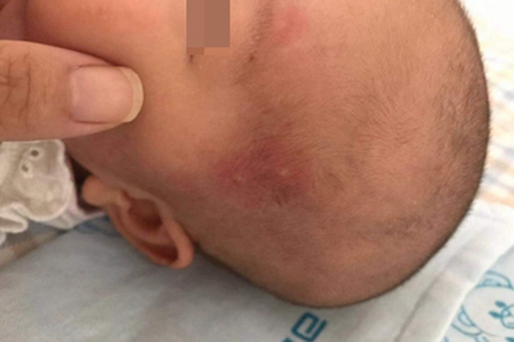 新生儿中毒性红斑头上长红斑图 新生儿中毒性红斑头上长红斑图