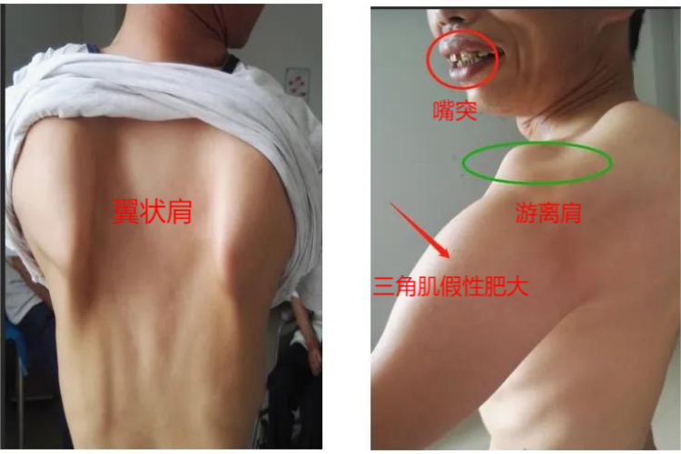 FHSD症状图