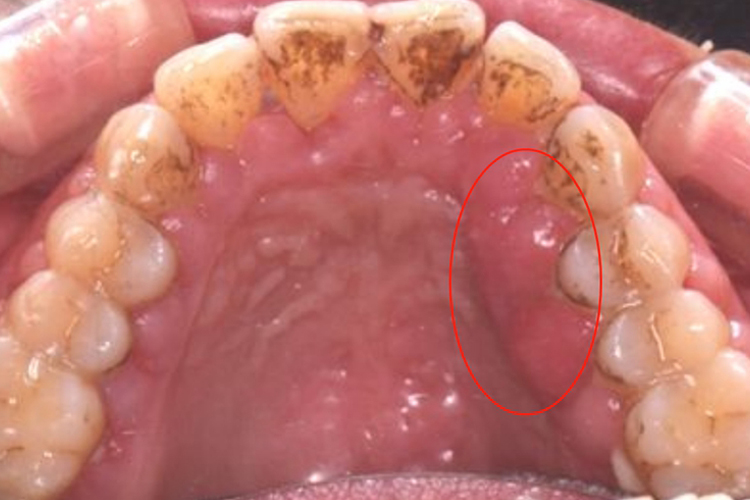 药物性牙龈增生图