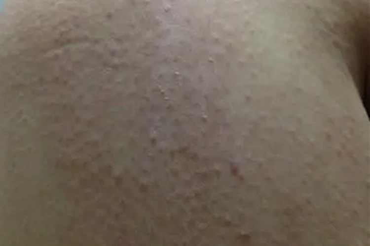 瘙痒症臀部小疙瘩图 瘙痒症臀部小疙瘩图