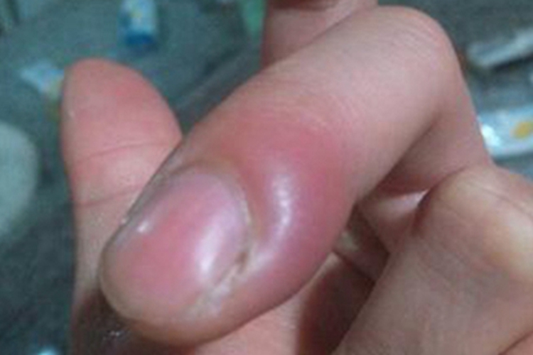 急性甲沟炎手指甲症状图 急性甲沟炎手指甲症状图