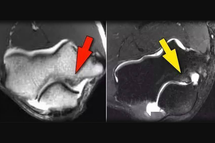肘关节软骨损伤影像图 肘关节软骨损伤影像图