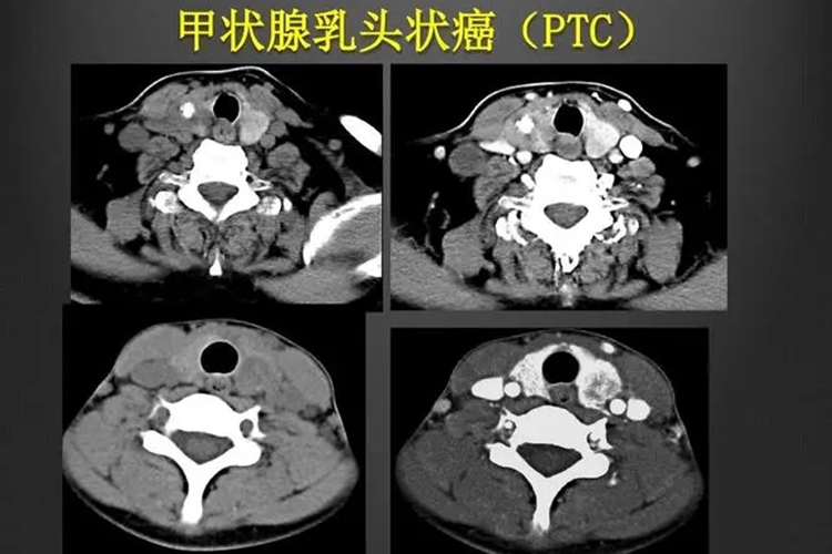 甲状腺乳头状癌影像学图 甲状腺乳头状癌影像学图