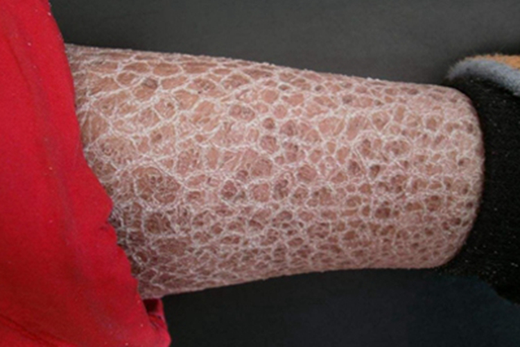 鱼鳞病小腿脱皮图