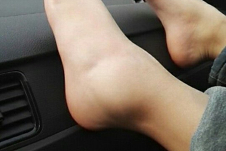 踝扭伤脚踝水肿图