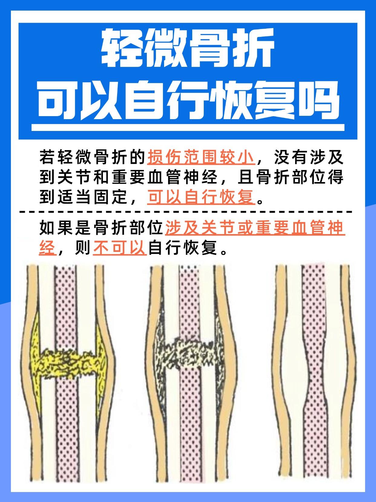 轻微骨折是否能自行恢复？一文了解