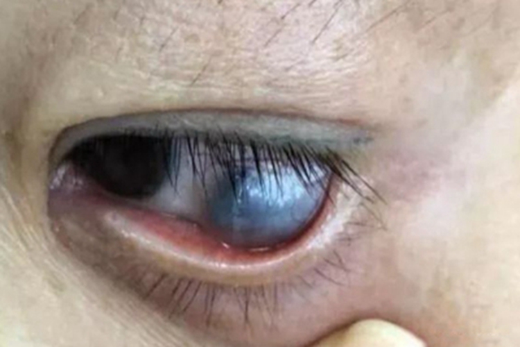 巩膜葡萄肿症状图 巩膜葡萄肿症状图