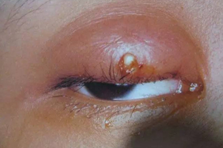 眼睑皮脂腺癌眼睑红肿图