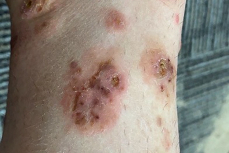 变应性皮肤结节性血管炎红斑图