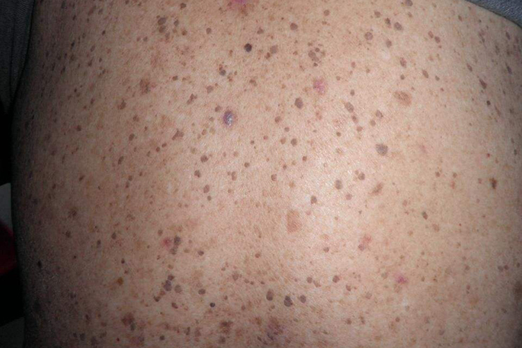 脂溢性角化病后背黑褐色斑图 脂溢性角化病后背黑褐色斑图