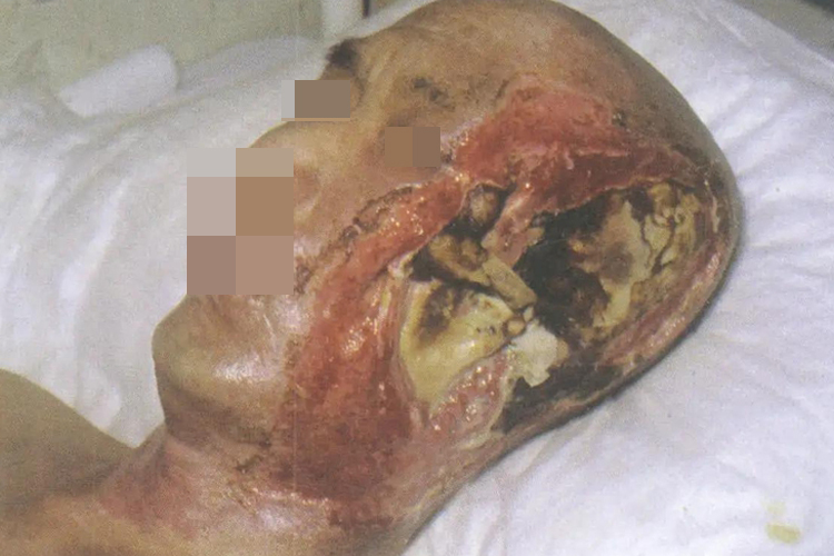 电烧伤面部化脓图 电烧伤面部化脓图