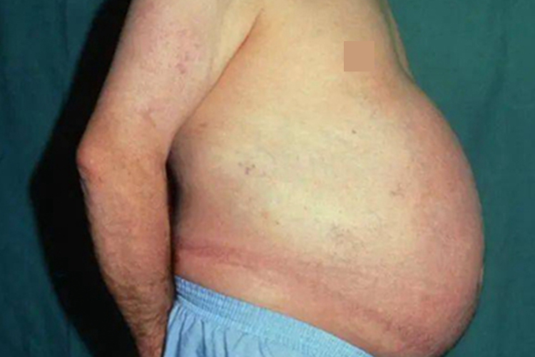 库欣综合征腹部症状图