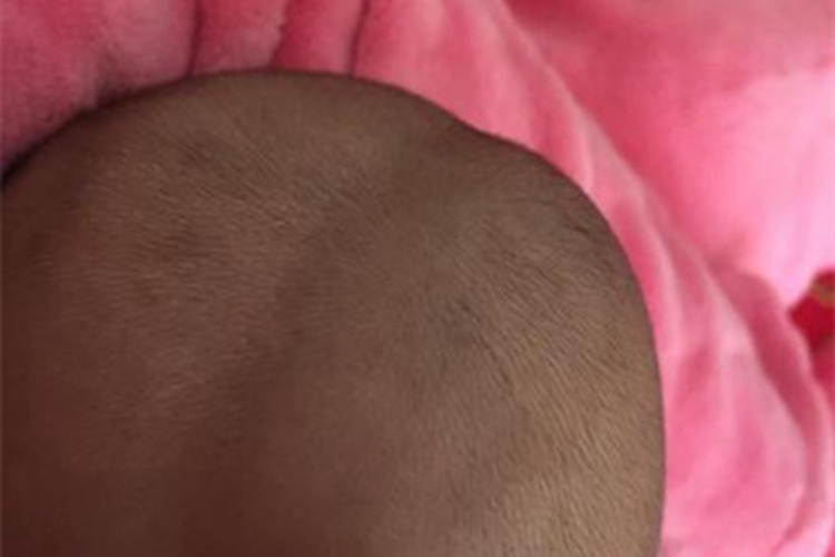 骨膜下血肿头部症状图