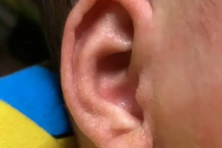 奶癣耳朵发红有小疙瘩图 奶癣耳朵发红有小疙瘩图