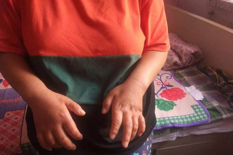 渐冻症手部萎缩图 渐冻症手部萎缩图