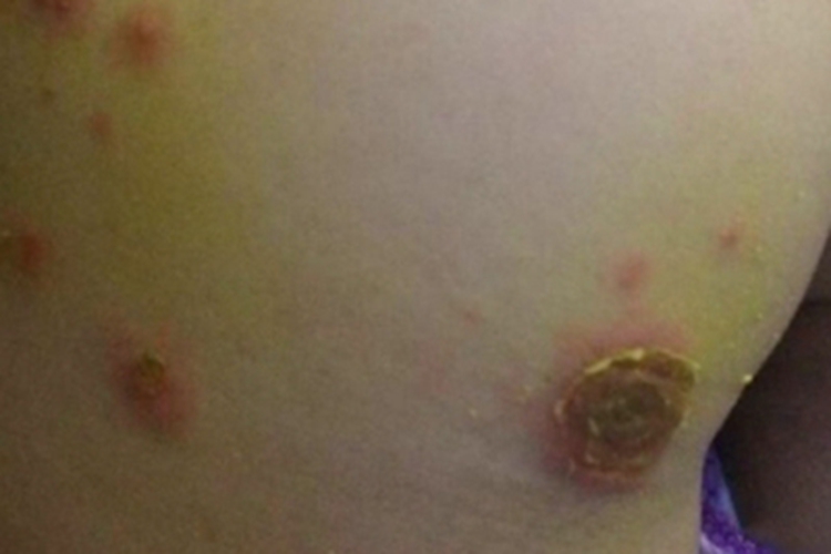 深脓疱疮臀部黄痂图