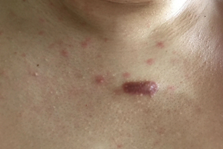 女性梅毒胸部症状图 女性梅毒胸部症状图