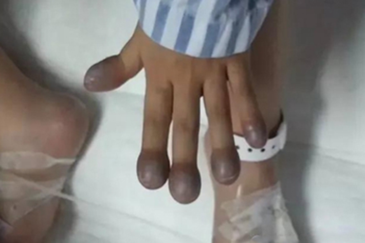 杵状指发紫图 杵状指发紫图