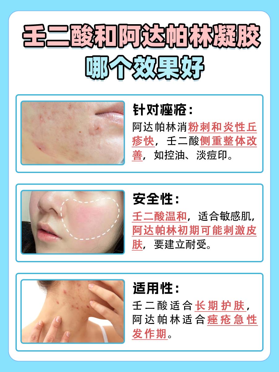 壬二酸和阿达帕林凝胶哪个效果好?一文解答
