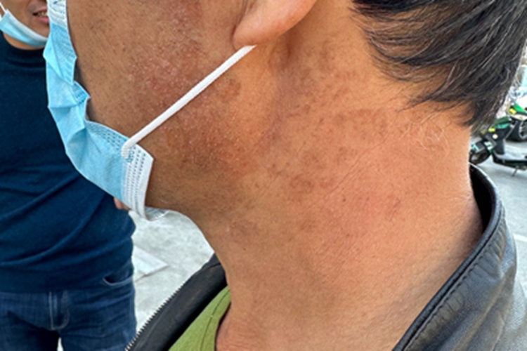 脂溢性角化病面部皮肤粗糙图