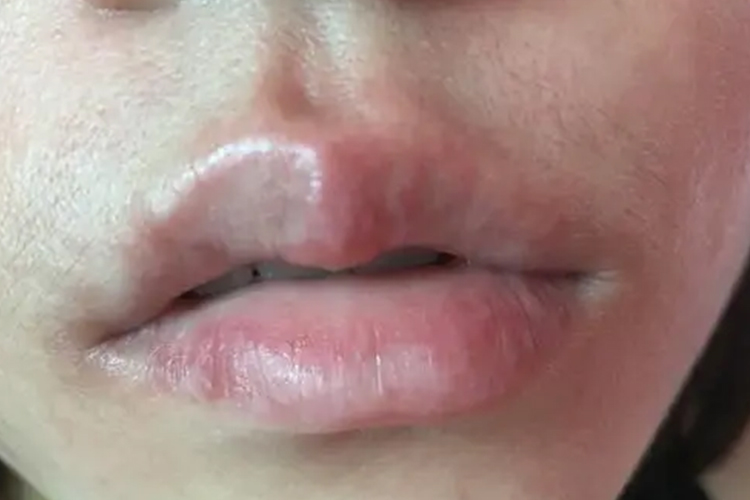 吃桃子过敏口唇红肿图
