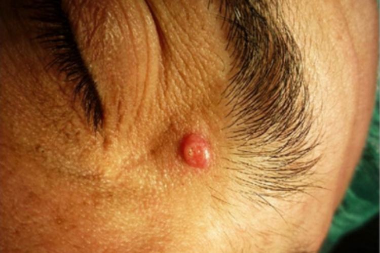 女性乳头状汗腺腺瘤眼周症状图 女性乳头状汗腺腺瘤眼周症状图