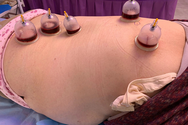 刺络罐法图 刺络罐法图